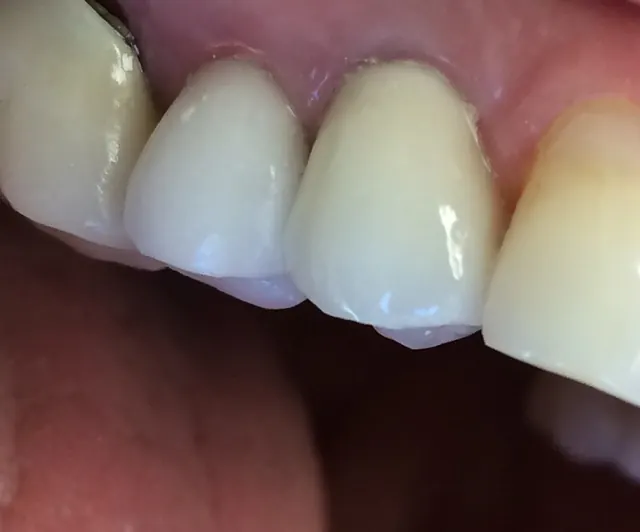 A finished implant crown in a patient's upper front teeth, matching the neighbouring teeth.