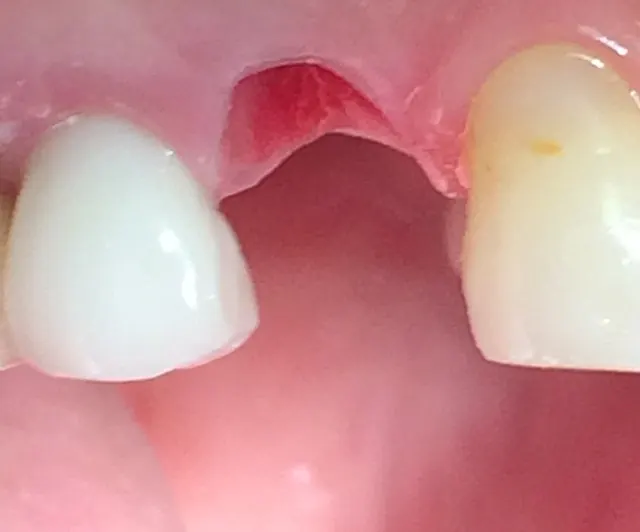 The broken tooth before treatment, with the gap where it had snapped off at the gum.