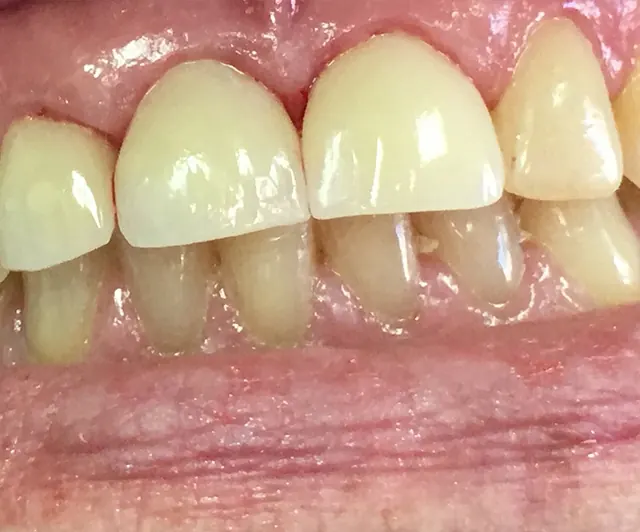 The same teeth restored with all-porcelain crowns, even and full length.