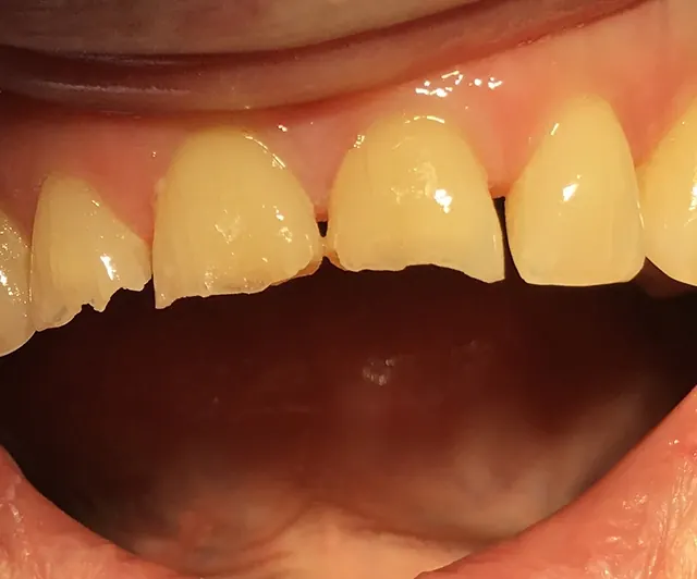 Upper front teeth worn short and chipped along their edges.